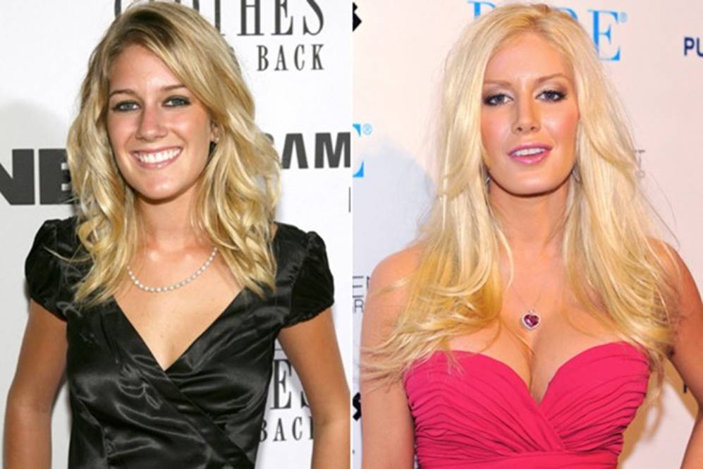 The Ever Changing Look Of Heidi Montag s Before And After Plastic 